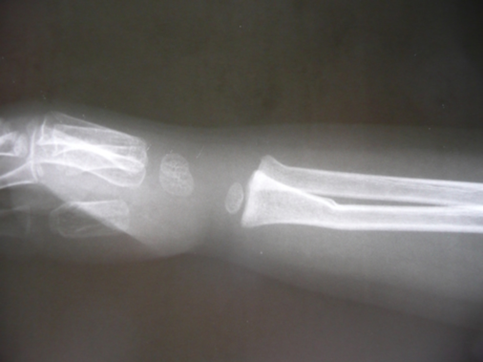 Greenstick fracture